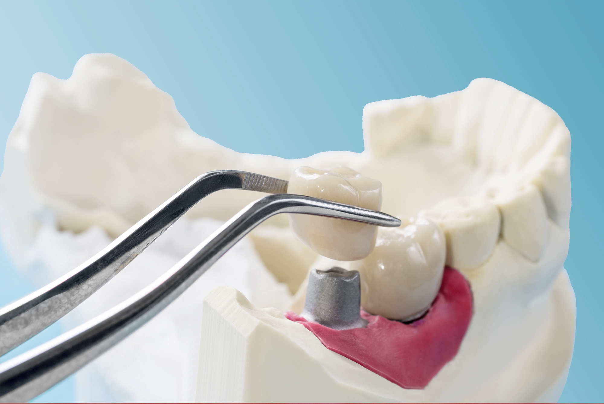 dental crowns