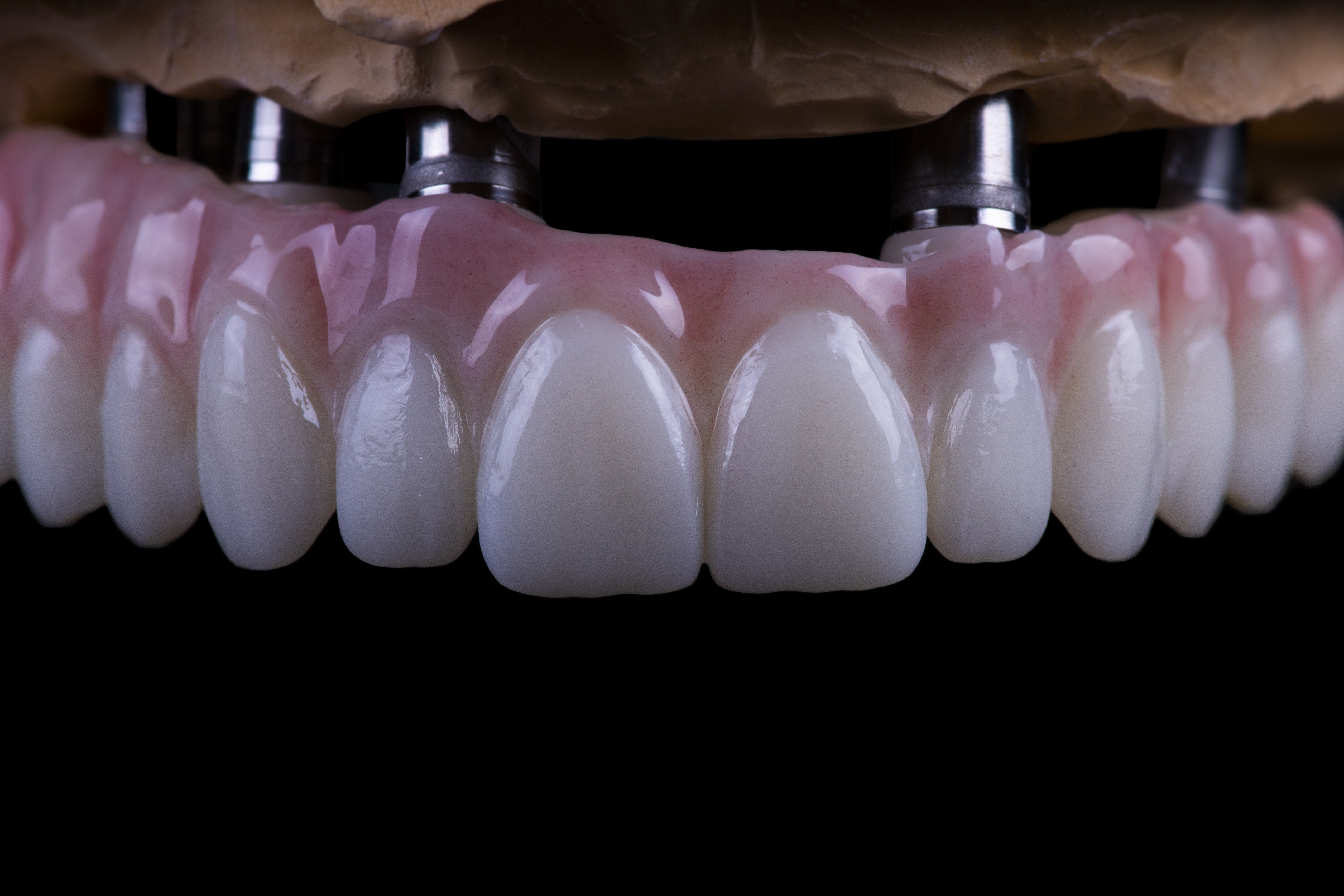 ceramic dentures