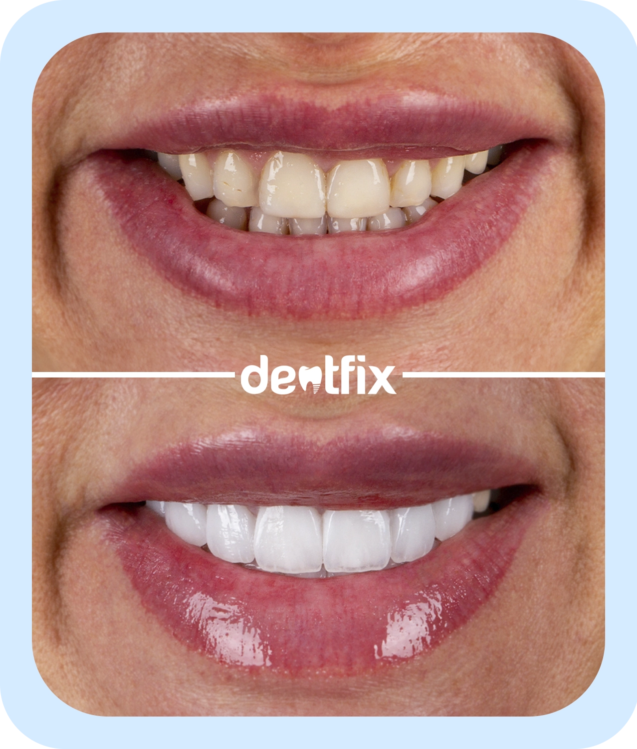 dental-veneers-1