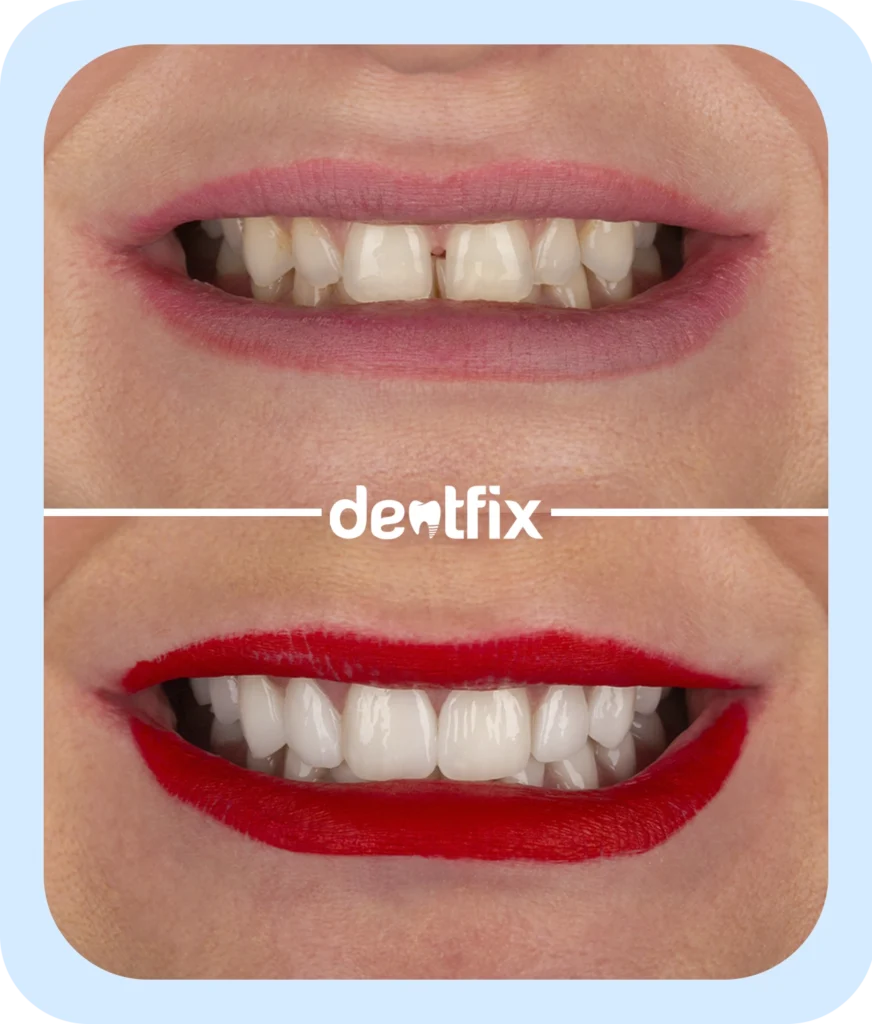 dental-veneers-2