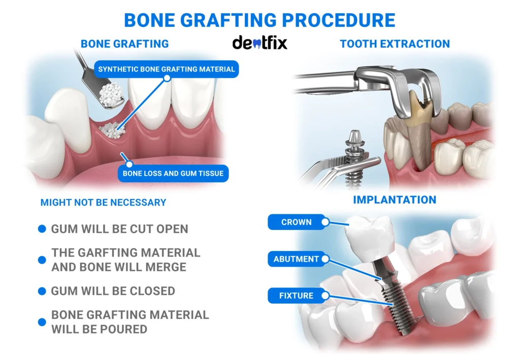 dental boe grafting procedure