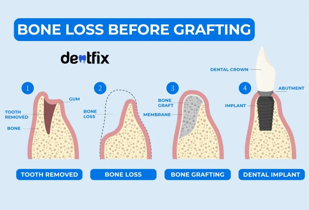 Bone Loss Before Grafting