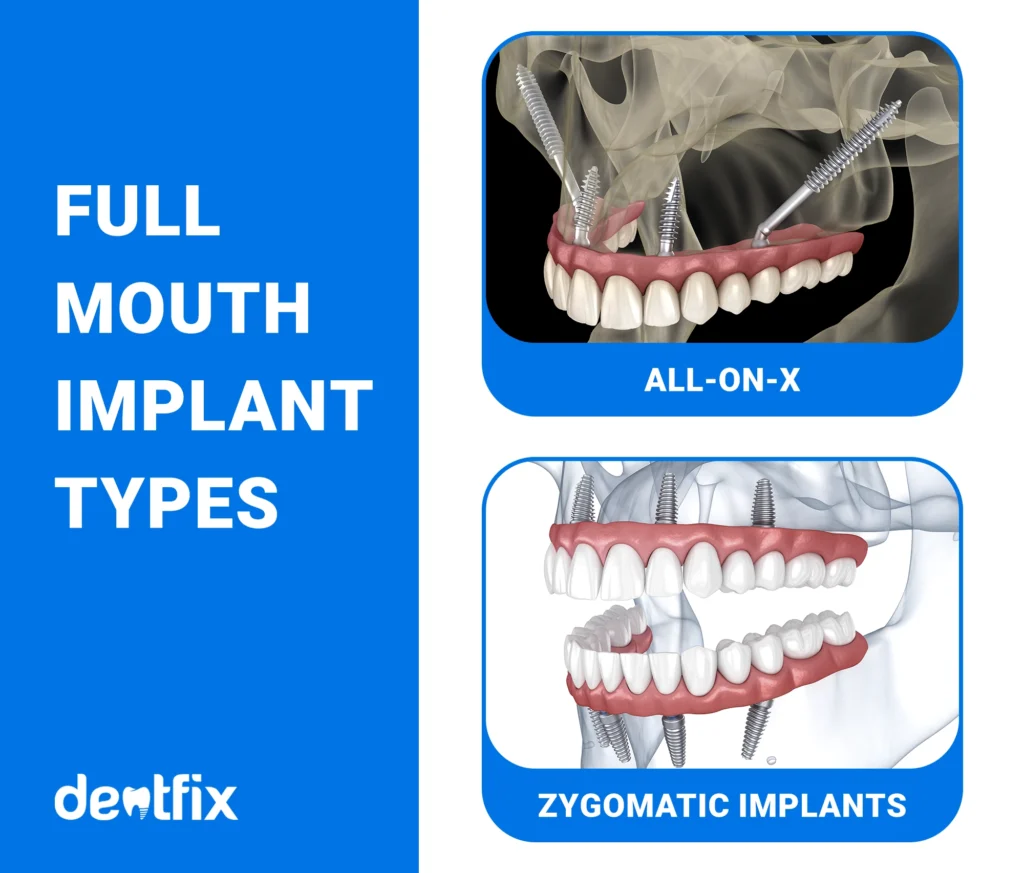 FULL MOUTH IMPLANT TYPES