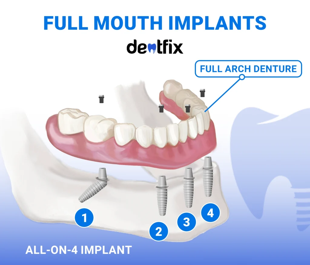 FULL MOUTH IMPLANTS-mobil