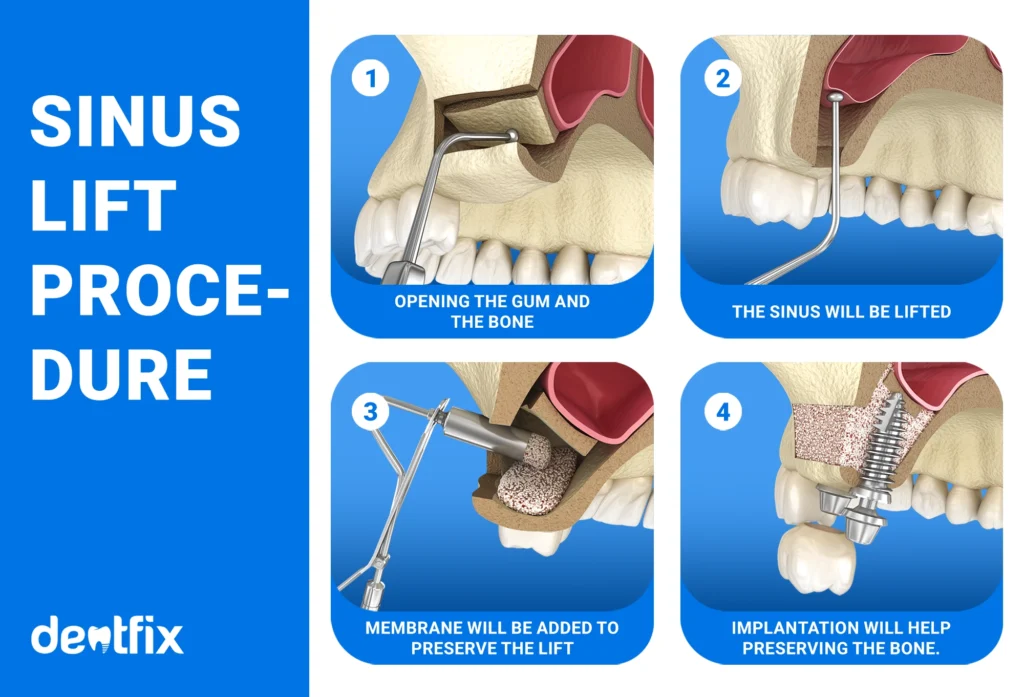 Sinus Lift Procedure