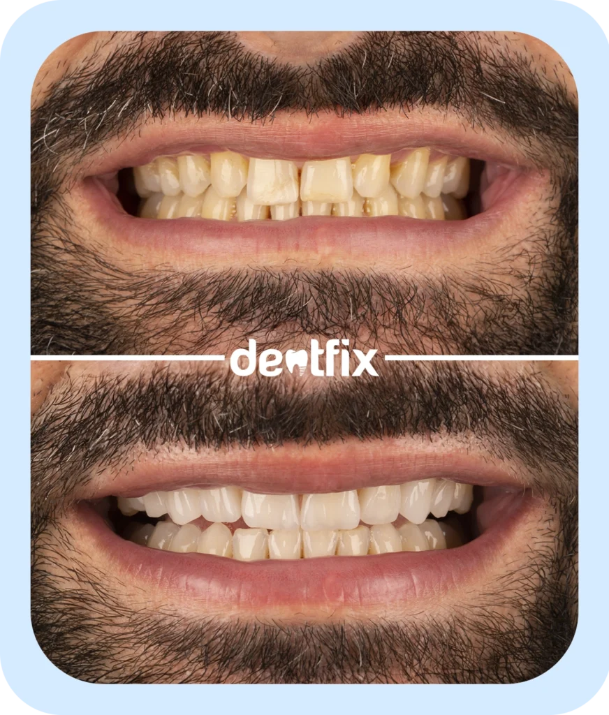 dental-veneers